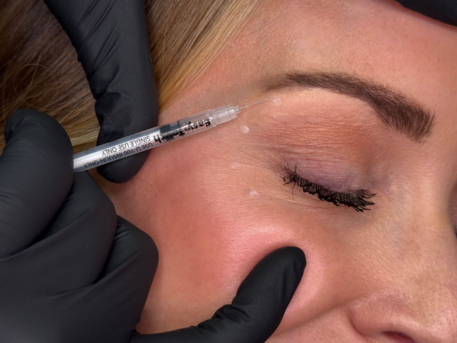 Gloved hand injecting cosmetic filler near a closed eye during a facial treatment